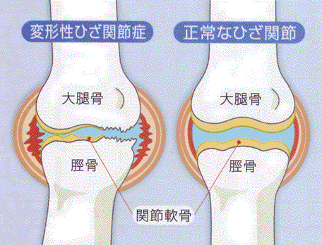 膝痛の原因・変形性膝関節症
