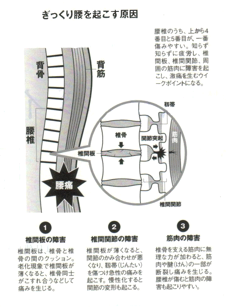 急な腰痛、ぎっくり腰の原因