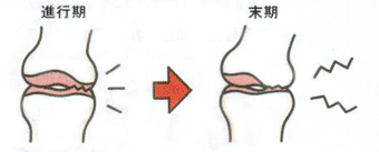 �G�̒ɂ݂̌o�߂Q