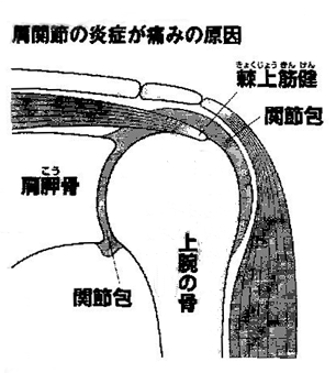 五十肩・四十肩の痛みは肩の関節の炎症