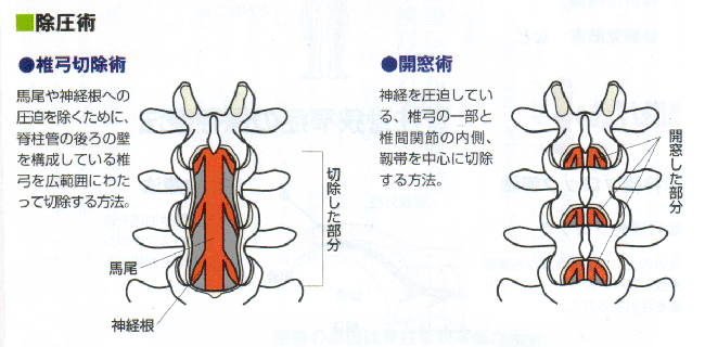 脊柱管狭窄症の手術