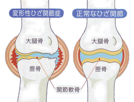 膝の痛みの原因と対策 はつらつライフ