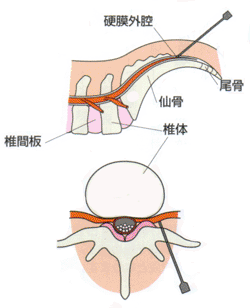 脊柱管狭窄症の保存療法