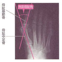 外反母趾の原因と対策