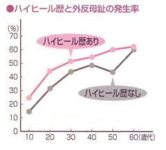 外反母趾の原因と対策