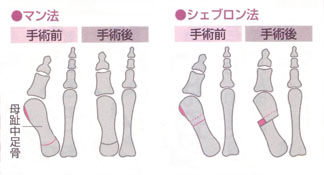 外反母趾の原因と対策