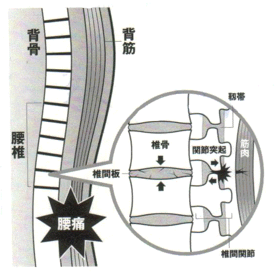 ぎっくり腰を起こす原因