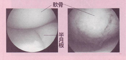 膝痛の内視鏡治療