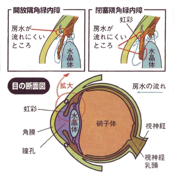 忍び寄る　緑内障