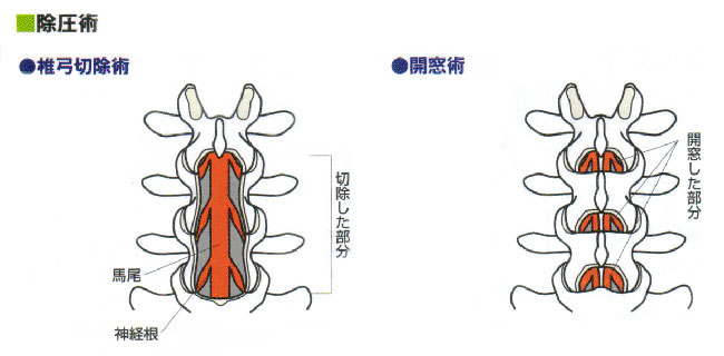 脊柱管狭窄症の手術