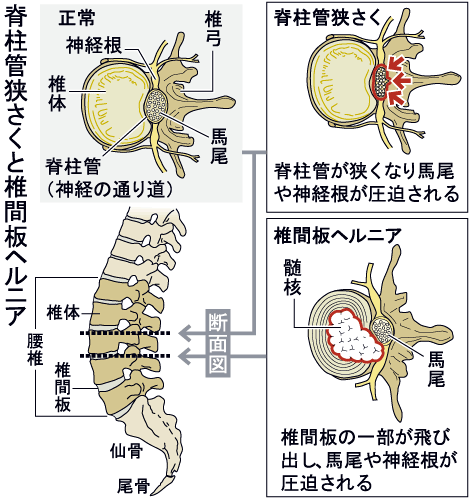 脊柱管狭窄症と椎間板ヘルニア