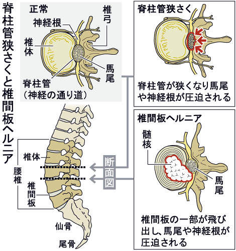 椎間板ヘルニアの症状【はつらつライフ】